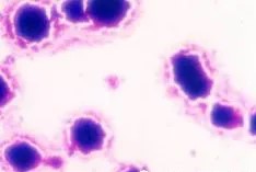 血清β2微球蛋白：肾脏健康的“预警器”