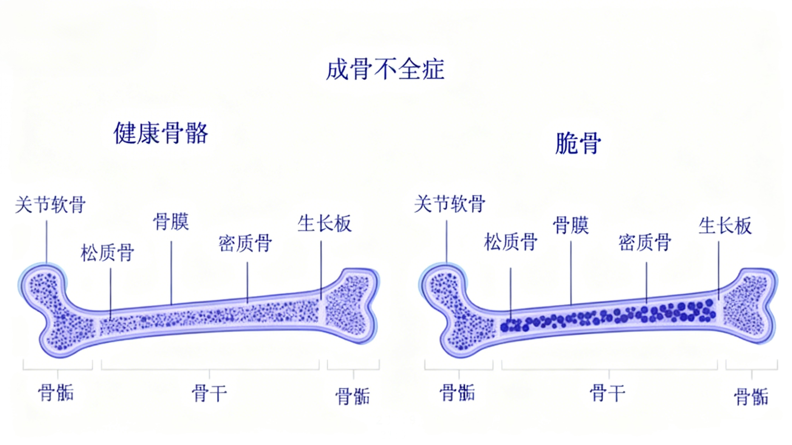 DKK-1能否成为成骨不全症的新型治疗靶点？